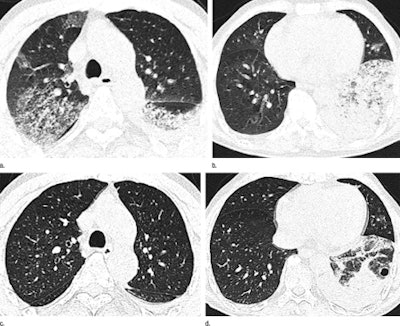 Axial thin-section CT images in 65-year-old man with H7N9 influenza. Top row, initial images obtained at admission show extensive GGOs and consol­idation. Bottom row, images at seven-day follow-up show complete resorption of the lesion in the right upper lobe and partial resorption in the left lower lobe with a round cystic change. Images republished with permission of RSNA from Radiology July 2, 2013.