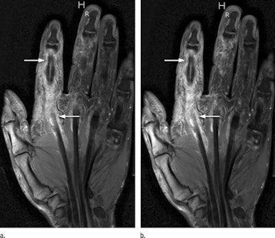 T1-weighted, fat-saturated, postcontrast 3-tesla MRI shows a half dose (a) and a full dose (b) of gadobenate dimeglumine in a 47-year-old man with early rheumatoid arthritis. The tendon sheath of the flexor tendons illustrates increased synovial enhancement, with tenosynovitis of the second flexor tendon scored as grade 3 (arrows) at both half dose and full dose. Images courtesy of Radiology.