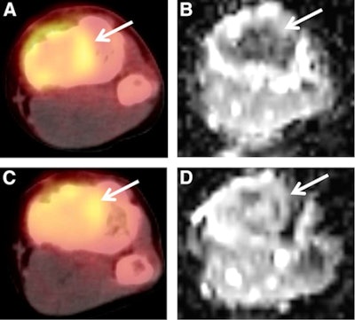 A 15-year-old male patient with osteosarcoma of the left tibia showed good histologic response after completing neoadjuvant chemotherapy. Although the patient was classified as a poor responder based on SUV change, he was classified as a good responder based on ADC change or the combination of SUV change and ADC change. Baseline transverse PET/CT image (A) shows increased FDG uptake of tumor with SUVmax of 2.9. Postchemotherapy PET/CT image (C) shows residual FDG uptake with SUVmax of 2.0, for an SUV change of -31%. In the baseline ADC map (B), mean ADC of tumor was 1.092 x 10-3 mm2/sec. In the postchemotherapy ADC map (D), mean ADC was 1.612 x 10-3 mm2/sec, for an ADC change of 47.6%. Images courtesy of JNM.