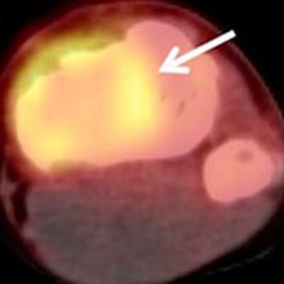 2013 07 10 14 53 40 631 Jnm Pet Ct Mri Osteosarcoma Byun 450 20130710215753