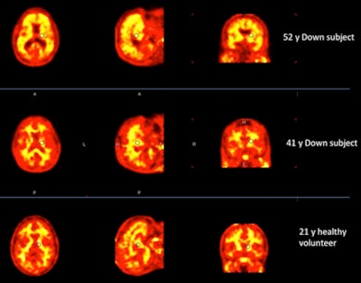 Florbetaben-PET images of three subjects. A 52-year-old with Down syndrome shows beta-amyloid deposits (yellow) extending to the edge of the brain, which indicates uptake in gray and white matter. A 21-year-old healthy subject shows only white-matter uptake, which does not extend to the edge of the brain. Results for the 41-year-old are similar to those of the healthy subject. Images courtesy of Dr. John Seibyl.