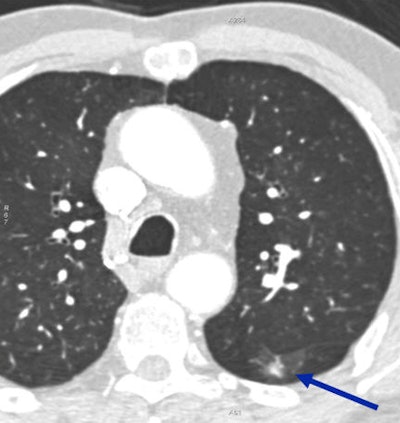 Incidentally detected solid nodule (arrow) turned out to be lung cancer.