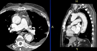 Acute aortic dissection tops the list of urgent findings requiring immediate care. All images courtesy of Dr. Charles White.
