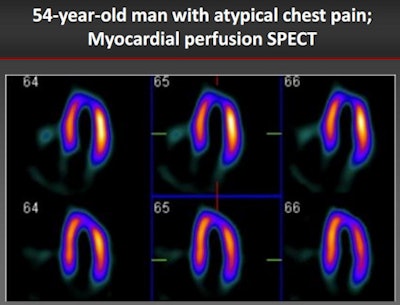 In a 54-year-old man with suspected coronary artery disease, SPECT shows an abnormality in the apex (above), but CCTA (below) shows the coronary arteries are clear.