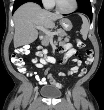 Coronal abdominal/pelvic CT image performed with IV contrast and the mixing and administration protocols listed above. Imaging performed 77 minutes after initiation of oral contrast administration.