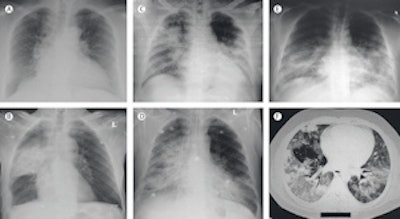 Imaging findings at presentation in Saudi patients with MERS