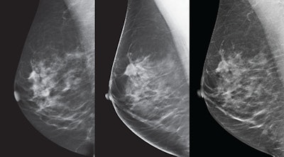 Breast images from the SenoClaire tomosynthesis system. Left: 2D mediolateral oblique (MLO) view. Middle: 3D MLO view. Right: V-preview reconstructed image.