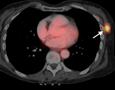 Fused ontrast-enhanced PET/CT image shows a metabolically active lesion