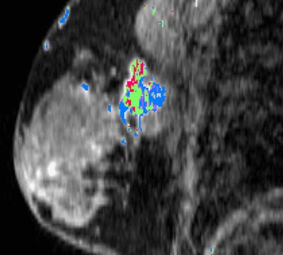 Above: A lesion is found in the upper outer left breast through postgadolinium DCE-MRI with a SER-based color map overlay that shows high washout kinetics (red). Below: A fused contrast-enhanced PET/CT image shows a metabolically active lesion (arrow). Images courtesy of Radiology.