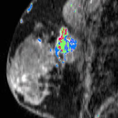 Study links triple-negative breast cancer on MRI, PET/CT scans