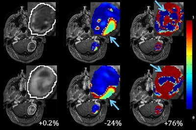 MR images of tumor response to treatment