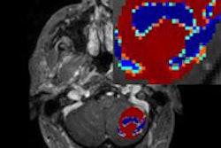 2013 08 02 15 29 21 960 2013 08 05 Mri Brain Tumor 200