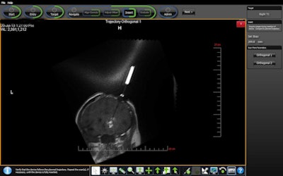 UCSD researchers used the ClearPoint guidance system with MRI scans to direct gene therapy for brain tumors. Image courtesy of UCSD.