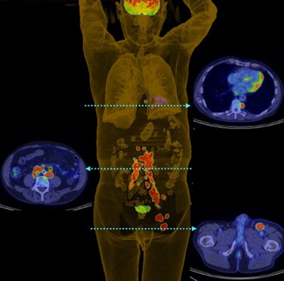 PET 3D reconstruction shows left inguinal nodal and extensive retroperitoneal and thoracic nodal metastases in patient with Merkel cell carcinoma of the left lower limb. Image courtesy of the Journal of Nuclear Medicine.