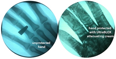 Bones are visible on a hand exposed to fluoroscopy without the protection of Ultra Blox x-ray attenuating cream. Bones are not not visible when the cream is applied. All images courtesy of BloXR.