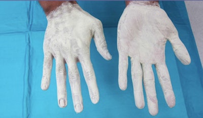 Hands after application of the x-ray attenuating cream.