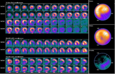 Regadenoson stress Rb-82 PET MPI