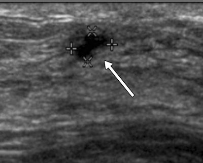 Sonograms show a BI-RADS category 3 lesion (arrow) in a 43-year-old woman. The lesion was described as 5-mm clustered microcysts at one-year follow-up (above). At two-year follow-up (below), the lesion had suspicious changes and was reclassified as a BI-RADS category 4A solid lesion. The lesion was not detected with mammography in either year. At biopsy, the lesion was determined to be an 18-mm invasive lobular cancer. Images courtesy of RSNA.