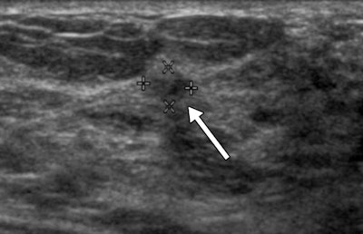 BI-RADS 3 lesion at 2 years
