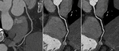 Three CT scans obtained in patients with different kV setting techniques and data reconstruction protocols. Left: kV set based on patient BMI; center: kV set automatically using APSCM technique with FBP reconstruction; right: kV automatically set using APSCM technique with SAFIRE reconstruction. All images republished with permission from RSNA.