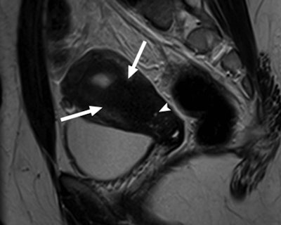 Sagittal T2-weighted MRI of a 24-year-old woman with cyclical pelvic pain in the largest rudimentary uterus (80 mL). Image shows three-layer differentiation and extensive adenomyosis with thickening of the junctional zone (arrows) and small hemorrhagic foci (arrowhead). Image courtesy of Radiology.
