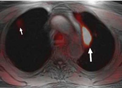 PET/MRI of a 63-year-old man with a history of lung cancer who underwent diagnostic PET/CT to assess tumor burden. Image shows a left upper lobe lesion (large arrow). A right upper lobe lesion was also found due to FDG avidity. Image courtesy of Radiology.
