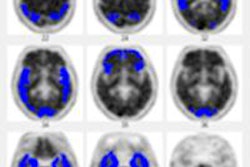 2013 09 05 14 26 22 894 Neuro Q36 Amyloid Uptake 400 20130909203322