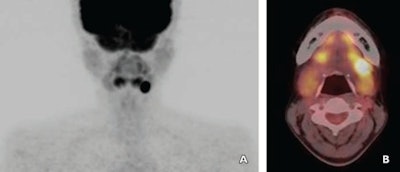 Images are of a 38-year-old woman with a left submandibular gland tumor. A maximum intensity projection image (A) and fused PET/CT image (B) were obtained. Early-phase SUVmax, delayed-phase SUVmax, and retention index for the tumor were 17.4, 23.1, and 32.8%, respectively. The tumor was diagnosed as pleomorphic adenoma. Images courtesy of AJR.