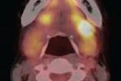 2013 09 06 15 02 27 706 Pet Ct Salivary Gland Ajr 500 20130906220845