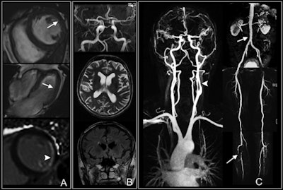 Whole-body MRI shows multiple findings in a 74-year-old man with type 2 diabetes for 21 years. Cardiac images (A) show impaired function with anterolateral hypokinesia (arrows). Late gadolinium-enhanced image (bottom) shows enhancement of anterolateral myocardium (arrowhead) indicative of myocardial infarction. Cerebral images (B) show normal cerebral arteries. Vascular images (C) demonstrate 50% stenosis of left internal carotid artery (arrowhead) and luminal irregularities of the abdo­men (upper arrow), thighs, and lower leg with severe atherosclerotic disease and vessel occlusion (lower arrow). Images courtesy of Radiology.