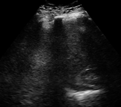 The upper pole of the kidney and the posterior diaphragm are clearly visible with the InnerVision system at an image depth of 300 mm. Premium-performance conventional systems routinely exhibit loss of penetration, detail, and visibility when imaging deep structures, especially in individuals with high BMIs, according to the company. Image courtesy of InnerVision.