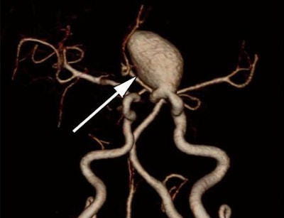 Volume-rendered image (above) and maximum-intensity-projection image (below) from a 47-year-old woman with a left internal carotid aneurysm (arrows). Images courtesy of Radiology.