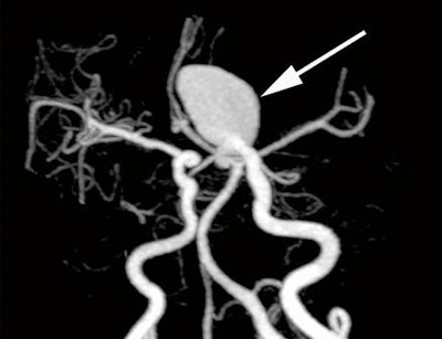 MIP image of aneurysm