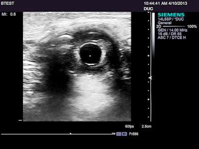 From the start of testing: my left iris and pupil; the central reflector is a Mittendorf spot. The image was converted to grayscale and the contrast was enhanced. This is a good target for assessing lateral resolution spread, dynamic range, and image noise, as well as how much of the display matrix is devoted to the ultrasound image. It is also excellent for assessing dynamics by following changes in pupil size with emotion and changes in ambient light.