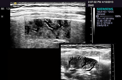 A grayscale composite of two images with the same probe but different magnifications, showing small peripheral vessels in the spleen and kidney.