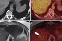 2013 09 16 16 56 27 387 Pet Mri Ct Radiology Catalano 440 20130916235822