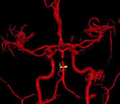 The above image shows a basilar artery dissection, where a portion of the arterial wall is torn and acts as a flap, impeding blood flow. On the image of the vasculature, it appears as a gap in the basilar artery. However, because basilar arterial flow was still in the indicated range, the patient elected not to have surgery. All images courtesy of VasSol.