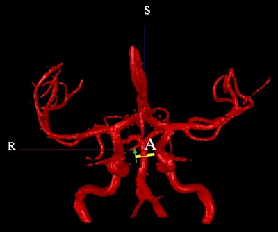 This image of the vasculature shows a perpendicular NOVA plane on the basilar artery, where Nova measures blood flow. The green arrow shows that blood is flowing normally to the posterior portion of the brain.