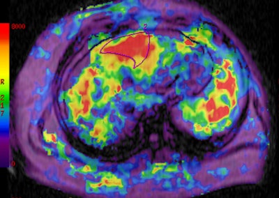 A 16-year-old girl with a history of NAFLD underwent liver MRE, which demonstrated liver stiffness consistent with severe fibrosis. The results were confirmed histopathologically on biopsy. Image courtesy of Dr. Stavra Xanthakos.