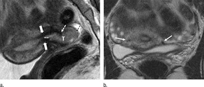 MR images show the tumor-to-internal-os distance and presence of deep cervical stromal invasion in a 23-year-old woman with stage IB1 invasive adenocarcinoma of the uterine cervix. Sagittal (left) and axial (right) images show a tumor (T) within 3 mm of the internal os. Images courtesy of Radiology.
