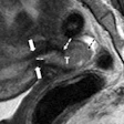 2013 10 02 16 29 05 799 Mri Tumor Internal Os Lahkman 500 20131002233139