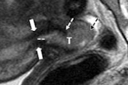 2013 10 02 16 29 05 799 Mri Tumor Internal Os Lahkman 500 20131002233139