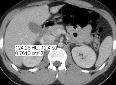 Standard-dose 30% ASIR