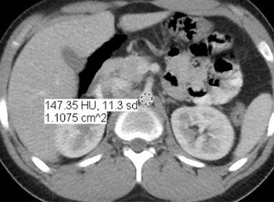 100% ASIR reduced-dose CT