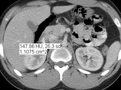 Reduced-dose filtered back projection