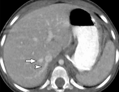 Reduced-dose axial CT images reconstructed with MBIR (above) and 100% ASIR (below) in a 30-month-old girl with a history of a malignant germ cell tumor in the right hepatic vein (arrow) and an accessory right hepatic vein (arrowhead). Images republished with permission of RSNA from 10.1148/radiol.13130362, October 3, 2013.