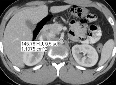Images are of a 17-year-old boy with a history of Hodgkin's disease. Reduced-dose MBIR image (above), reduced-dose 100% ASIR image (below), reduced-dose filtered back projection image (third from top), and comparison standard-dose 30% ASIR image (bottom), all with a region of interest in the abdominal aorta for objective noise measurement. The reduced-dose MBIR image has significantly less noise compared with other reduced-dose and standard-dose reconstructions. Images republished with permission of RSNA from 10.1148/radiol.13130362, October 3, 2013.