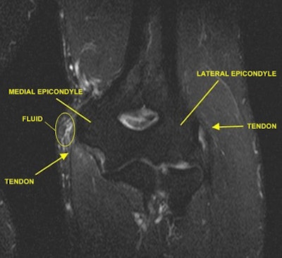 An MRI of an elbow indicates normal landmarks (yellow arrows).