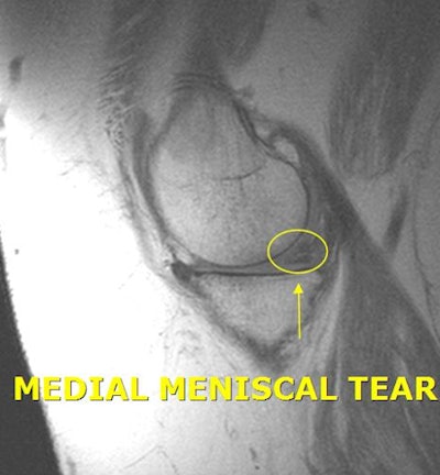 This MRI from InsideInjuries.com shows the location of a mensical tear. All images courtesy of Dr. Anand Lalaji.