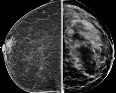 Craniocaudal mammograms of the same 70-year-old (left), rated type 1 density, and of the 42-year-old (right), rated type 4.
